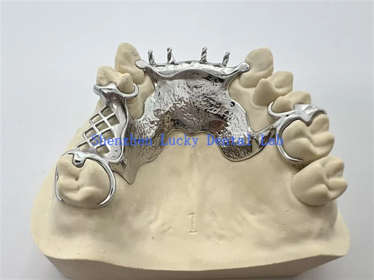 3D Print Lingual Phaj Hniav Hlau Cocr Mrodrch moj khaum nrog aker qawm